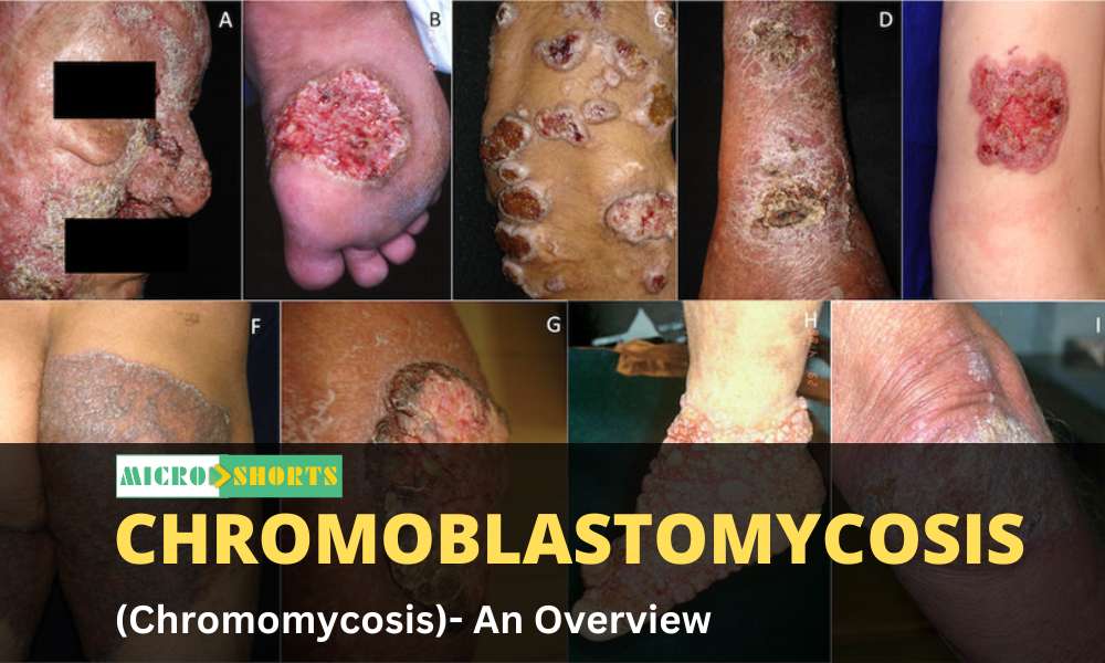 Chromoblastomycosis (Chromomycosis)- An Overview