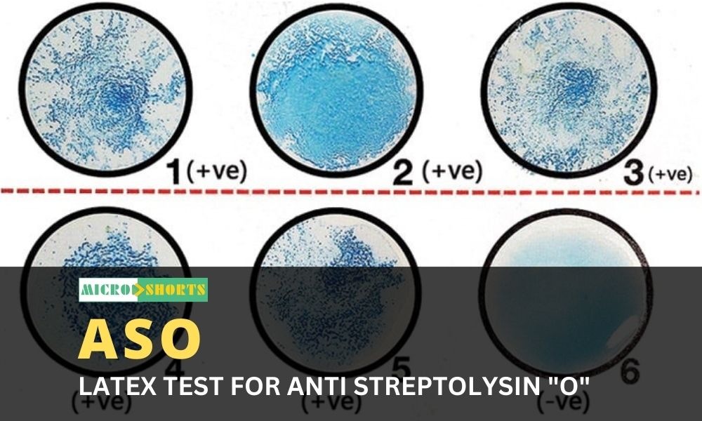 LATEX TEST FOR ANTI STREPTOLYSIN "O" (ASO)